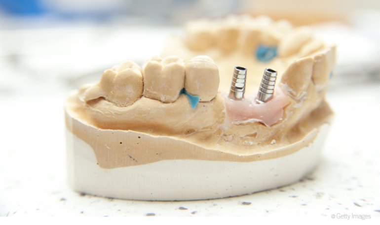 Dental implant trends