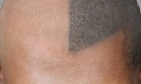Scalp Tattoo Micropigmentation – The Latest Trend In Hair Loss Treatment